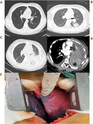 Very severe aplastic anemia in a child with pulmonary mucormycosis: a case report